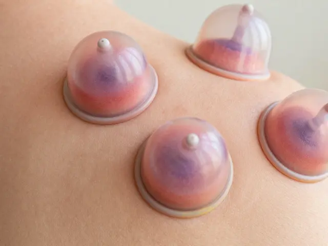 What are the downsides of cupping therapy? Risks and side effects explained
